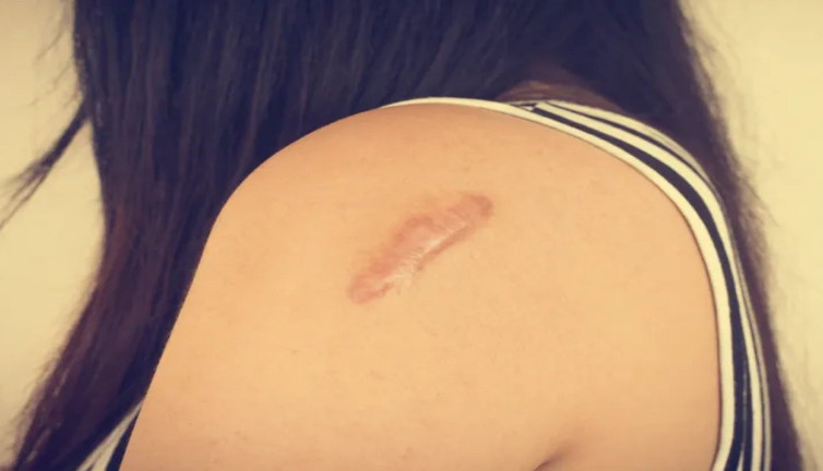 Kalıcı yara izlerine veda ettirecek formülleri uzmanlar anlattı