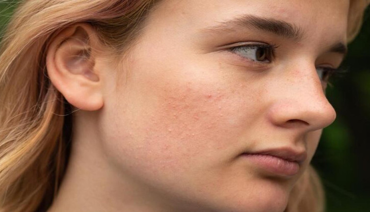 Cilt lekelerinin gizli nedeni ortaya çıktı! Uzmanlar ve bilim bakın ne diyor