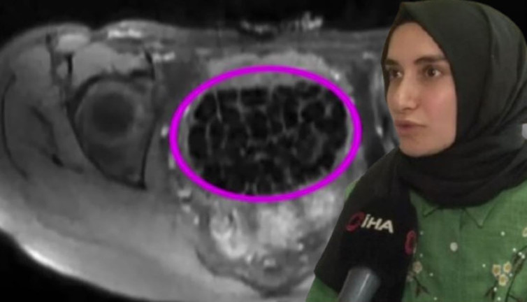 Karabük’te tıp literatüre girecek olay! Karın ağrısı şikayetiyle gitti: 287 taşı gören doktorlar şaşkına döndü