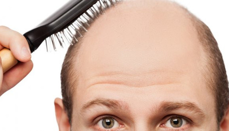 Saç dökülmesine ne sebep olur, nasıl önlenir?