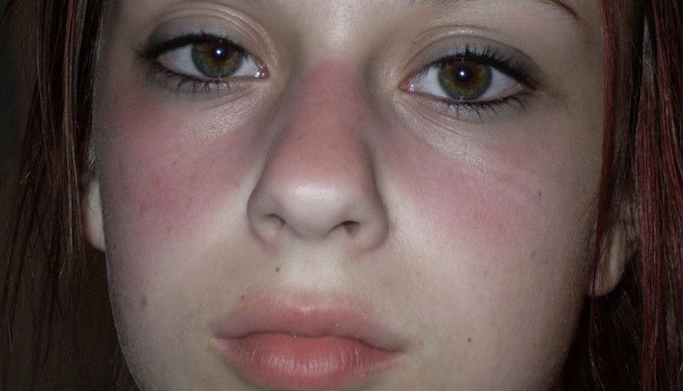 Lupus hastalığı nedir? Lupus ölümcül mü?