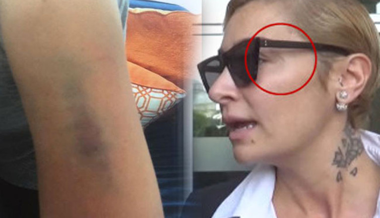 Ekimoz nedir? Ekimoz nasıl oluşur?