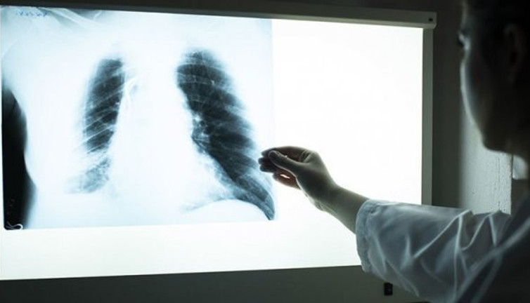 Aşırı kilolularda astım riski