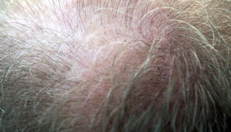 Üç aydan uzun süren saç dökülmelerine dikkat!