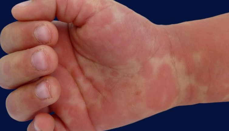 Ebeveynlerde 'kawasaki' hastalığı paniği