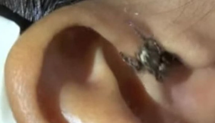 Doktorlar bile şaşırdı! Bu insanların içinden böcekler fışkırdı