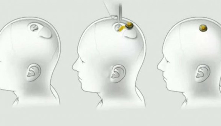 Elon Musk'ın dünyayı değiştirecek projesi Neuralink ,Türk halkına soruldu! Beyninize Neuralink çipi taktırır mısınız?