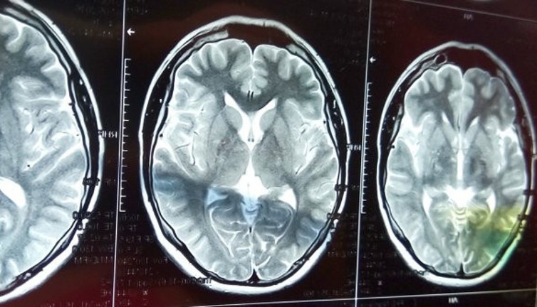 Koronanın uzun süreli bir etkisi daha ortaya çıktı. Yakalananlar kolay kolay atlatamıyor