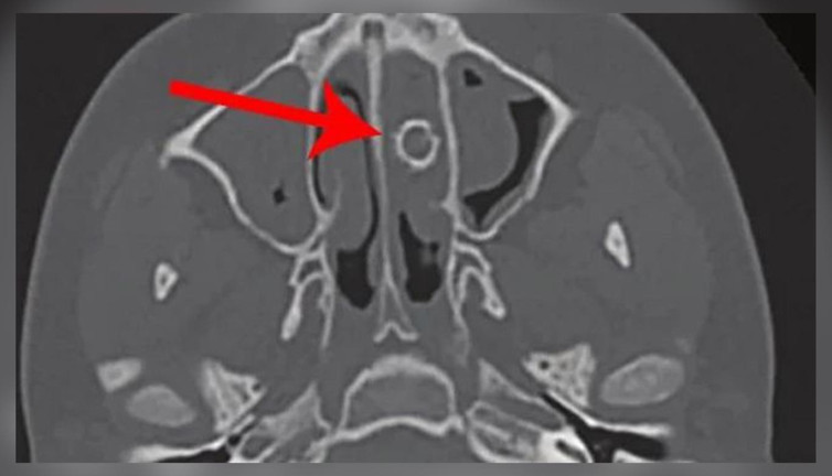 Kötü kokular geliyor deyince doktora gitti. Tam 8 yıl boyunca burnunda taşıdığı ortaya çıktı