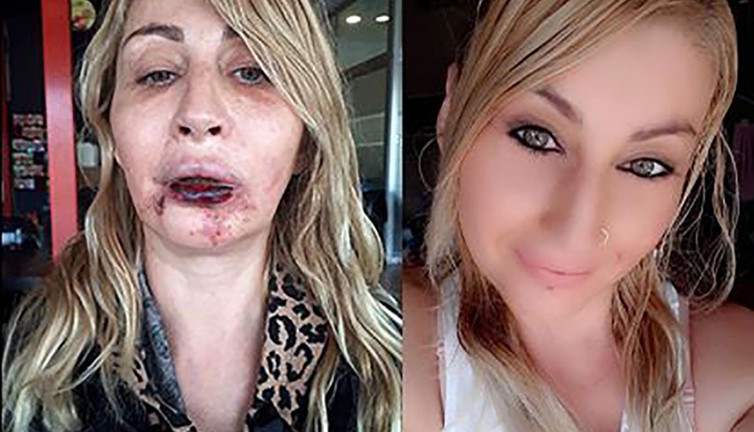 Estetik uğruna bu hale geldi. Canlı canlı çürüdü