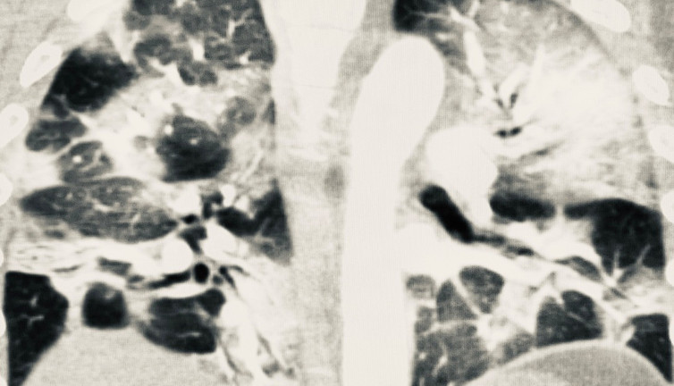 Aşı olanlarda korona virüs akciğere zarar vermiyor! İşte 2 kişiye ait tomografi sonuçları