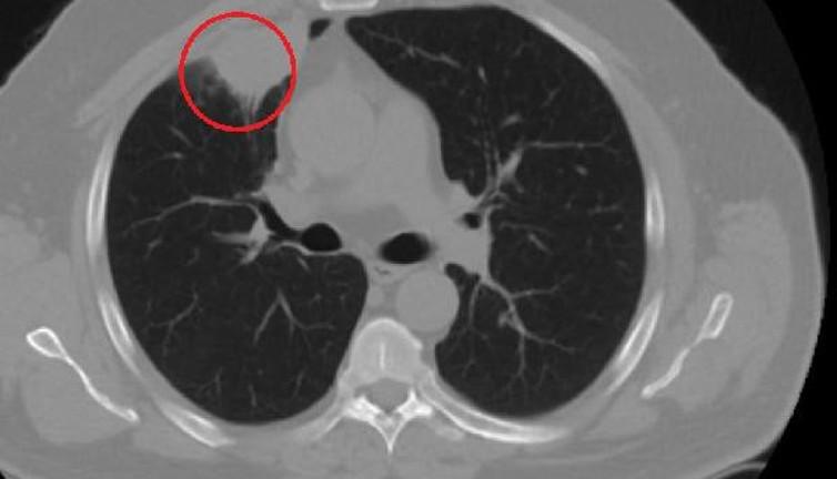 Dünya tıp literatüründe bir ilk. Korona akciğer kanserini taklit etti
