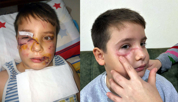 Köpekler saldırdığı için yüzüne 60 dikiş atılmıştı. Zavallı çocuk 36 gün sonra ilk defa dışarı çıkabildi