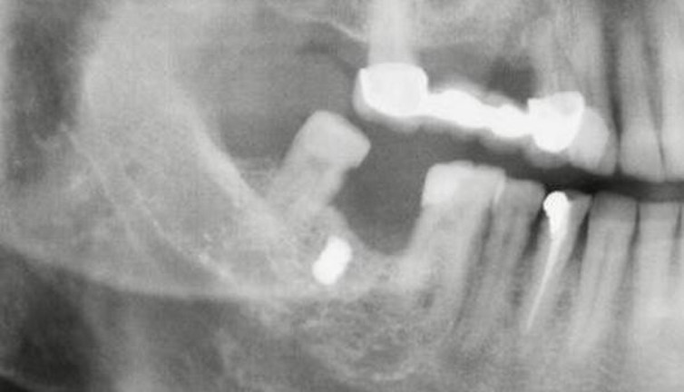 Diş tedavisi için doktora gittiğinde ortaya çıktı. Yanağında demir parçasıyla 15 yıl yaşadı