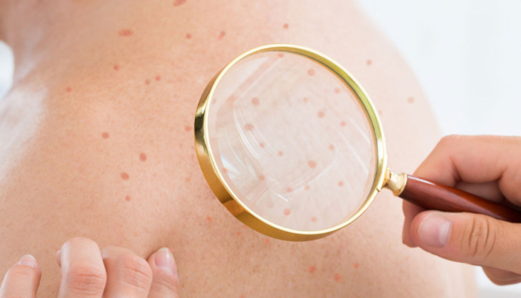 Cilt hastalıklarının kökeni psikolojik olabilir