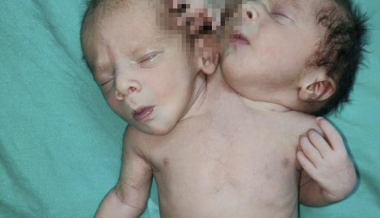 Çift başlı bebeği görenin ağzı açık kaldı