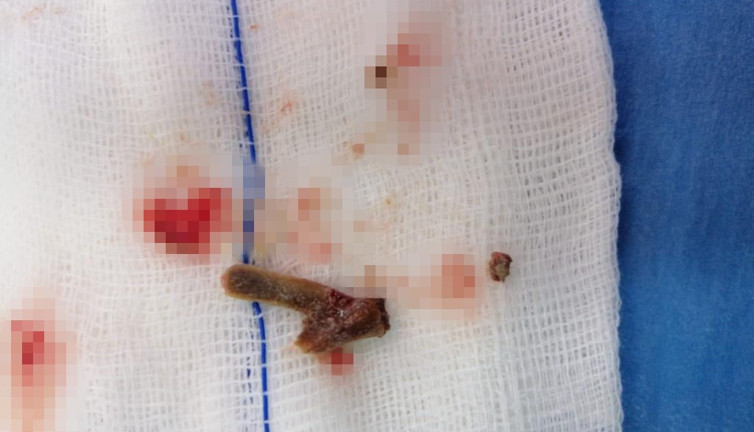 Öksürük şikayetiyle hastaneye gitti, 5 yıldır akciğerinde lades kemiğiyle yaşadığını öğrendi