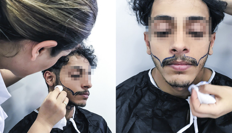 Saç ekimi yöntemiyle kaş ve sakal da ekilebiliyor