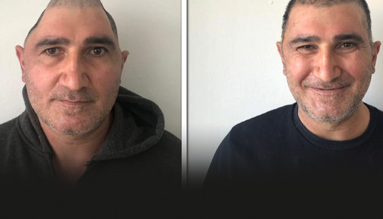 Kafatasının yüzde 83'ü parçalandı: Mucizevi yöntemle eski haline kavuştu!