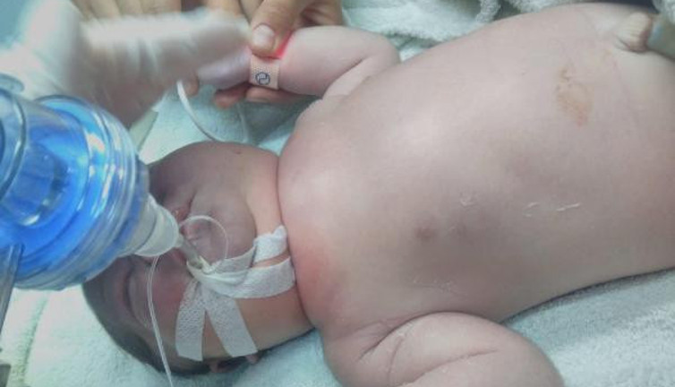 Doğumda köprücük kemiği kırılan bebek entübe edildi! Aile hastane ve doktor hakkında suç duyurusunda bulundu