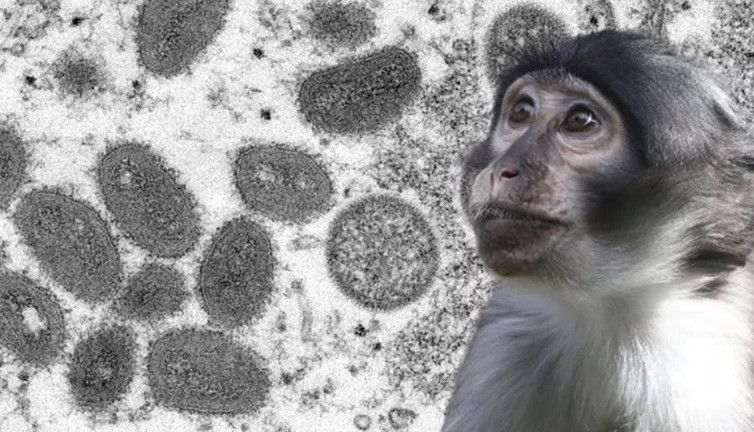 O ülkede maymun çiçeği vakalarında korkutan artış