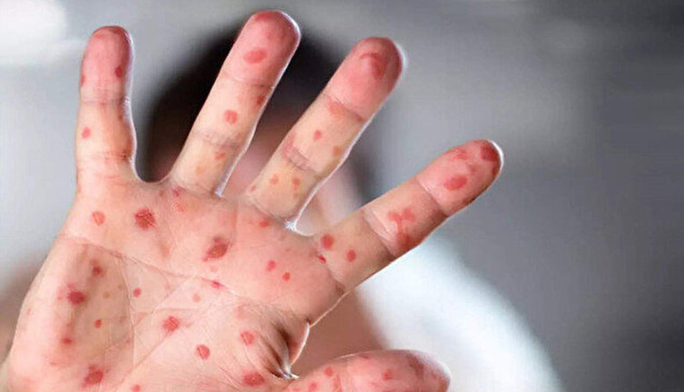 Dünya Sağlık Örgütü Maymun Çiçeği Virüsü vaka sayısını açıkladı. Pandemiye dönüşecek mi?