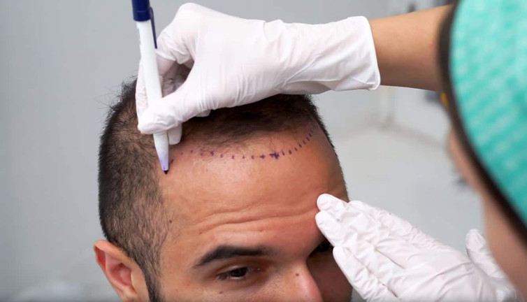 En İyi Saç Ekim Merkezi Hangisi? Yazın Saç Ekimi Yapılır mı? 2022 Saç Ekim Fiyatları Ne Kadar?