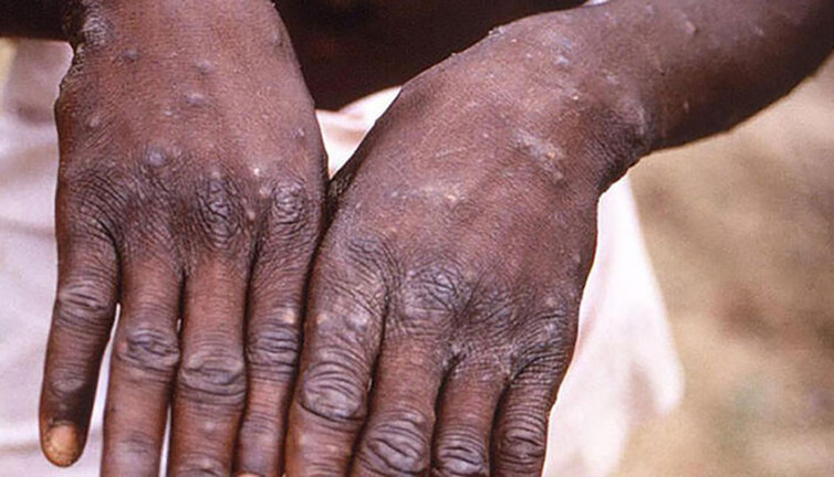 Dünya Sağlık Örgütü’nden flaş Maymun Çiçeği açıklaması