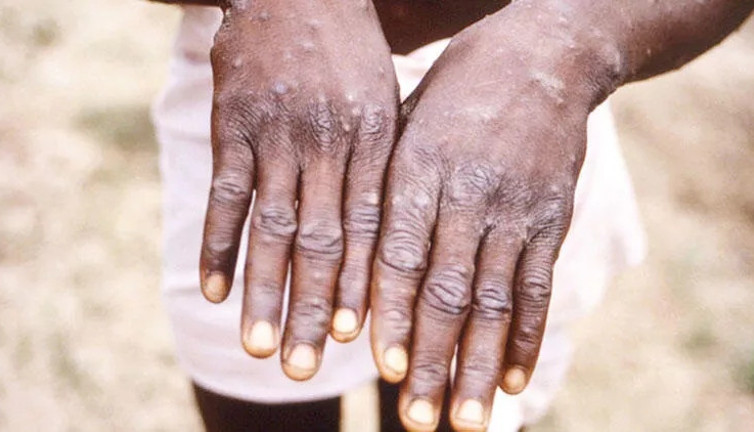 Son dakika | DSÖ maymun çiçeği için küresel acil durum ilan etti