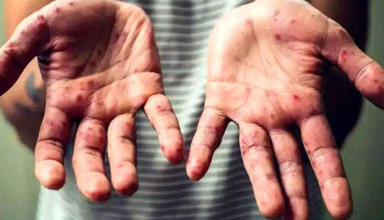 Fransa Sağlık Bakanı'ndan maymun çiçeği açıklaması: Genel hasta profili eşcinsel erkekler