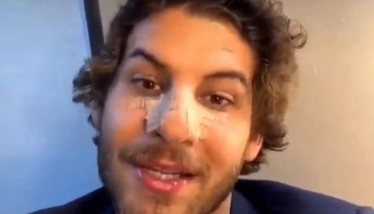 Mustafa Mert Koç'un burnu 4 yerinden kırıldı. Görenler önce estetik yaptırdığını iddia ettiler