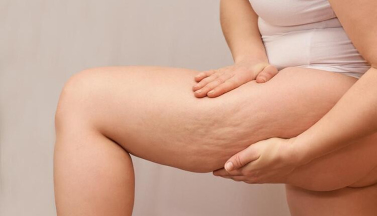 Cilt ve Güzellik Uzmanı selüliti olanların uzak durması gereken yiyecekleri açıkladı