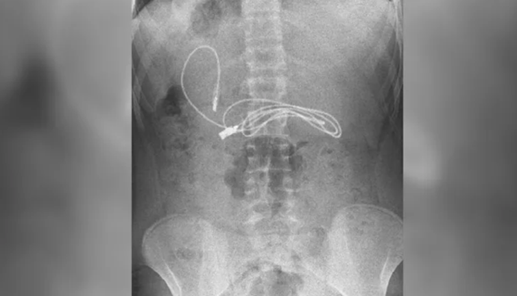 15 yaşındaki çocuğun midesinden çıkana doktorlar bile inanamadı