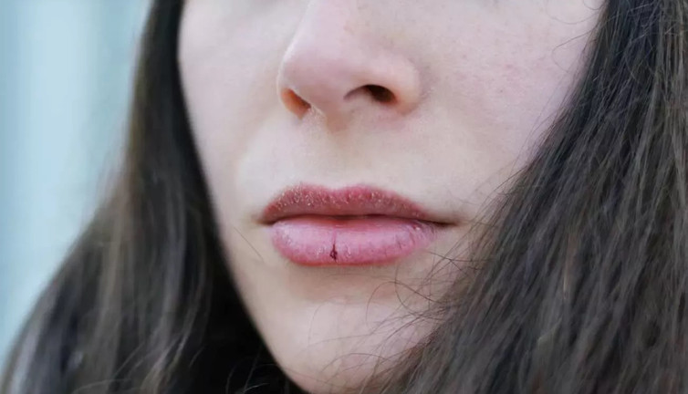Uzmanı açıkladı. Dudak çatlamasına karşı alınması gereken 7 önlem