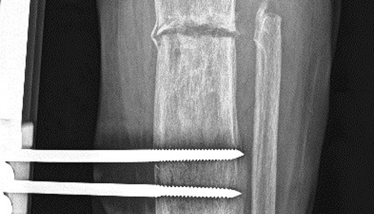 İş kazası geçiren hastanın mucize kurtuluşu