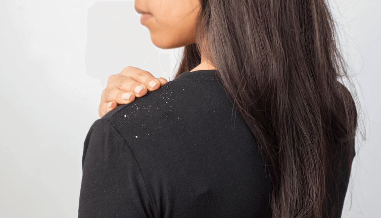 Kepek nedir nasıl geçer? Kepekli saça ne iyi gelir?