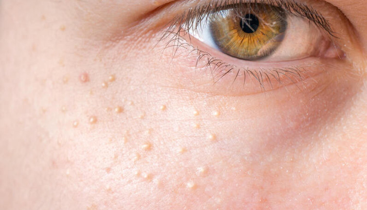 Yağ bezeleri nasıl geçer? Yağ bezeleri geçirmenin yolları neler?