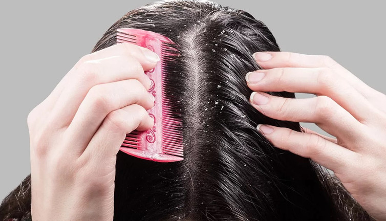 Kepeklere iyi geliyor. Mucize ot ortaya çıktı