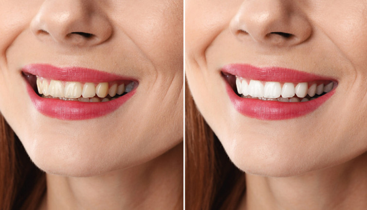 Diş Hekimi açıkladı. Dişlerin sararmaması için nelere dikkat etmeliyiz?