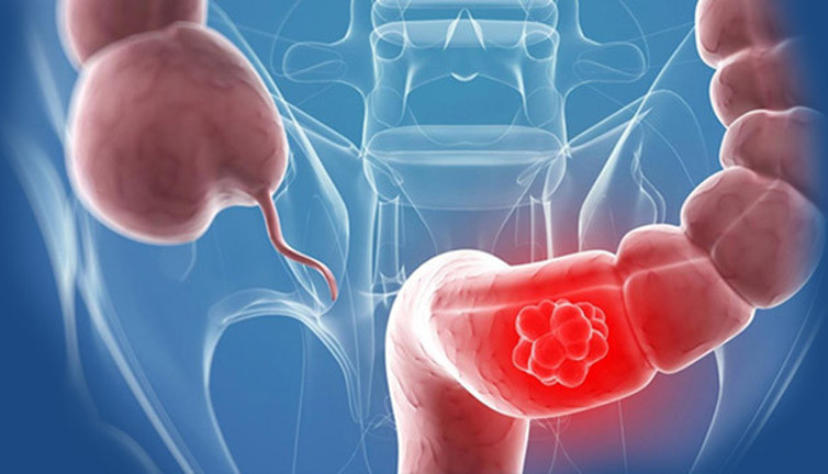 Geçen yıl ne kadar kalın bağırsak kanseri taraması yapıldı