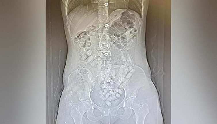 2 kadının midelerinden çıkanlar şoke etti! Tamı tamına 693 adet...