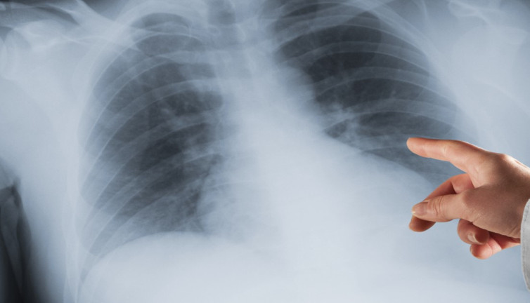 Amfizem hastalığı nedir, belirtileri neler? Amfizem hastalığı tedavisi var mı?