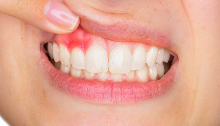 Mucize ot diş eti iltihaplarına iyi geliyor