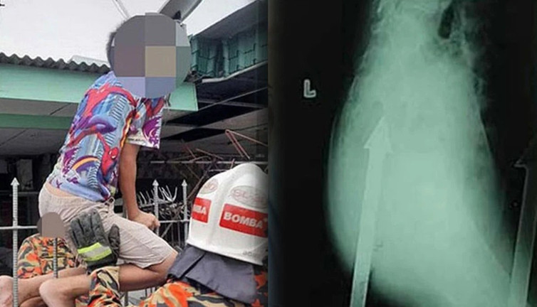 12 Yaşındaki çocuk bahçe demirine saplandı. Hastaneye korkuluklar içindeyken gönderildi