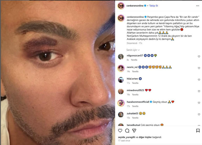 Ünlü şarkıcı Cenk Eren sahnede kaza geçirdi! Gözündeki morluk endişelendirdi - Resim : 2