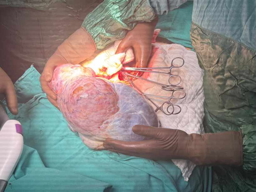 Karnından çıkana doktorlar bile inanamadı: Şişkinlik ve halsizlik şikayetiyle gitti! - Resim : 1