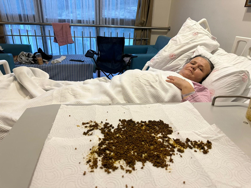 Doktorlar çıkan taşları saymakta zorlandı! Rekoru yapay zeka açıkladı - Resim : 1