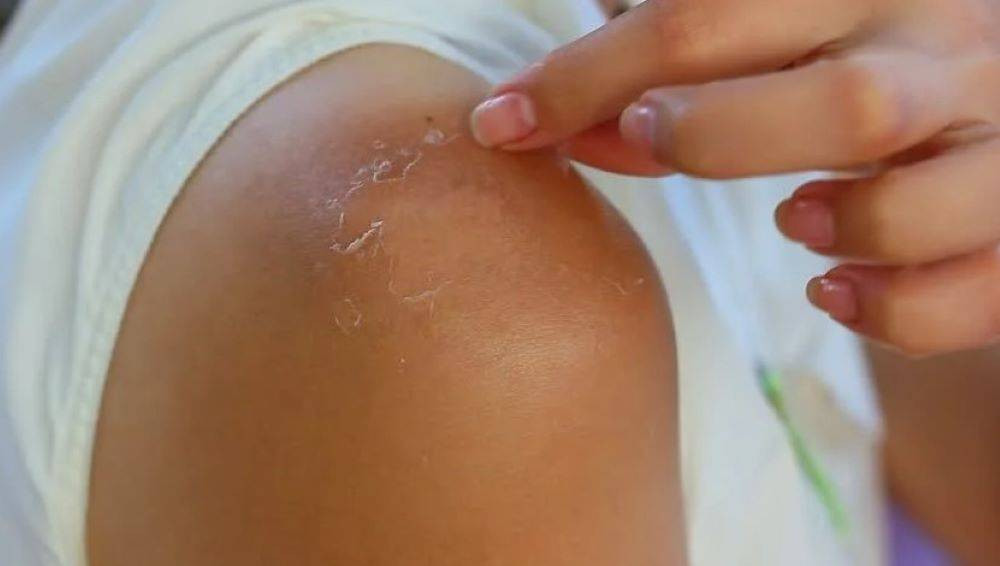 Güneşte yanan deri neden soyulur? Hücreler kendi yaşamına son verir ve vücuttan ayrılır - Resim: 11