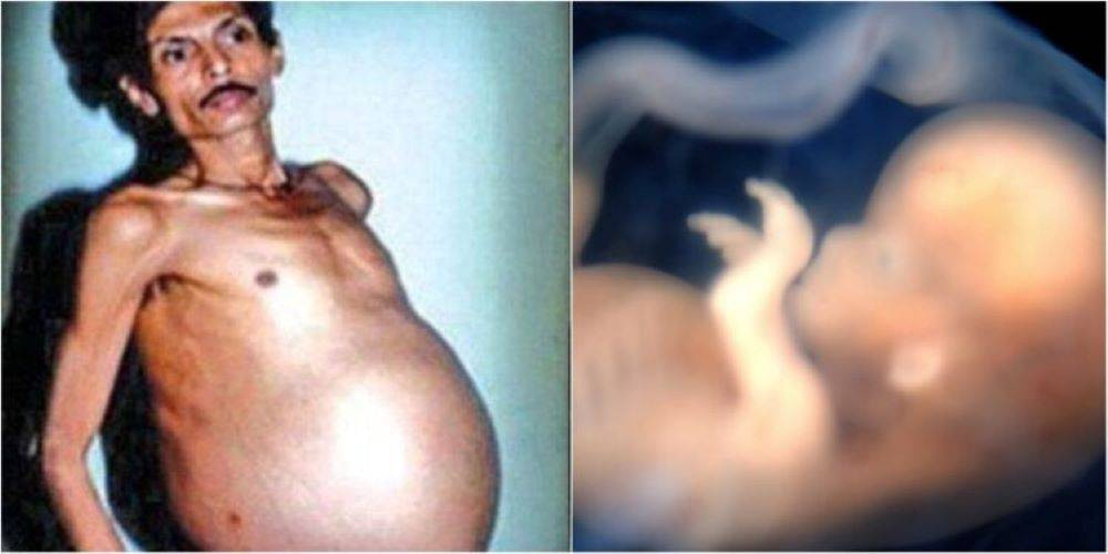 İkiz kardeşini 36 Yıl boyunca karnında taşıyan adamın sıra dışı hikayesini öğrenince şok olacaksınız - Resim: 5
