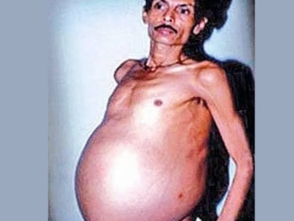 İkiz kardeşini 36 Yıl boyunca karnında taşıyan adamın sıra dışı hikayesini öğrenince şok olacaksınız - Resim: 3